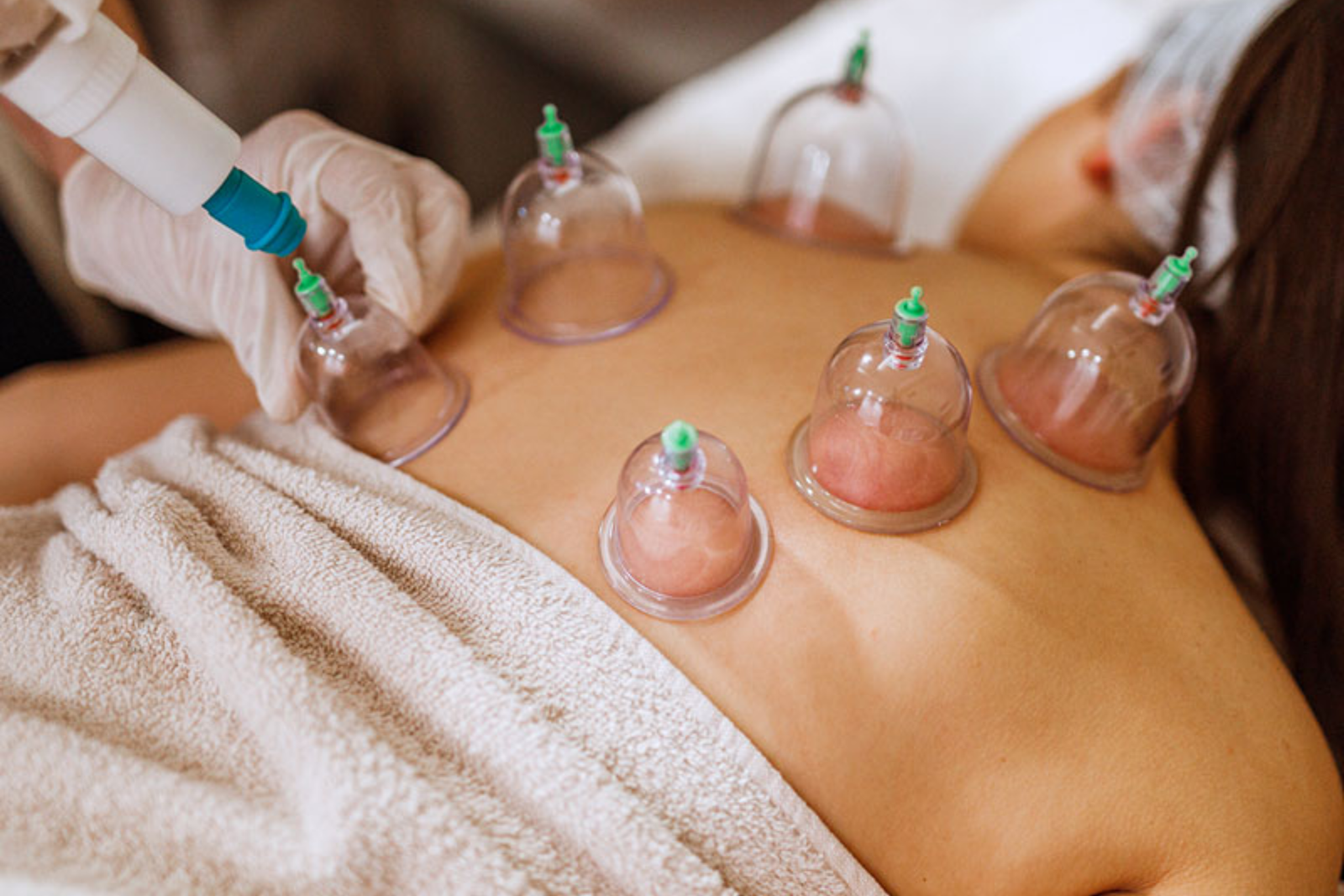 Cupping Therapy